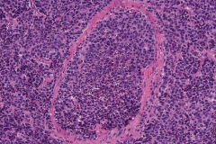 Large cell neuroendocrine carcinoma of the oropharynx