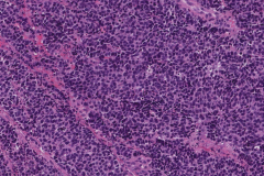 Large cell neuroendocrine carcinoma of the oropharynx