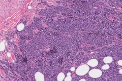 Large cell neuroendocrine carcinoma of the parotid gland