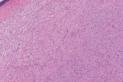 Neurofibroma in a patient with neurofibromatosis type 1