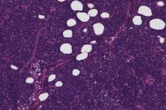 Nodal marginal zone lymphoma