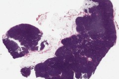 Nodal marginal zone lymphoma