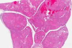 Nodular follicular disease of the thyroid gland