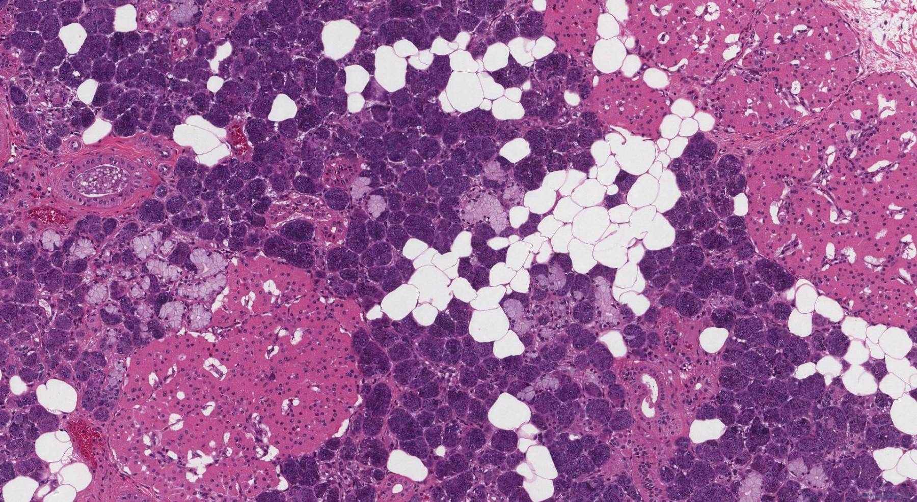 Nodular oncocytic hyperplasia of the salivary glands | Atlas of Pathology