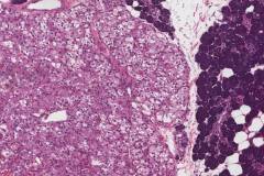 Nodular oncocytic hyperplasia of the parotid gland