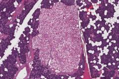 Nodular oncocytic hyperplasia of the parotid gland