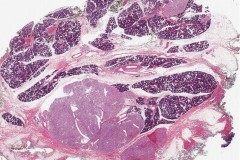 Nodular oncocytic hyperplasia of the parotid gland