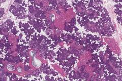 Oncocytosis of the parotid gland