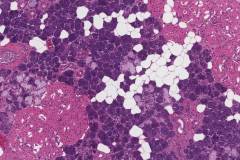 Oncocytosis of the parotid gland