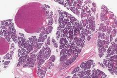 Oncocytosis of the parotid gland