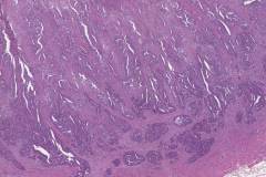 Non-ampullary adenocarcinoma arising from an adenoma in the duodenum