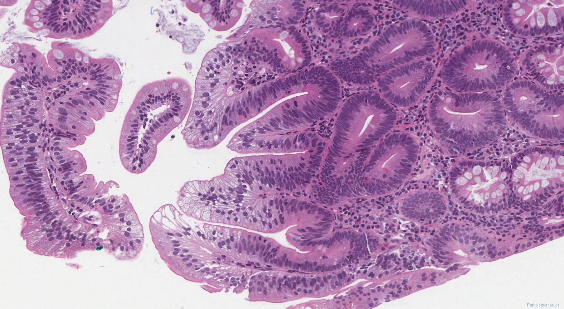 Non-ampullary duodenal adenoma | Atlas of Pathology