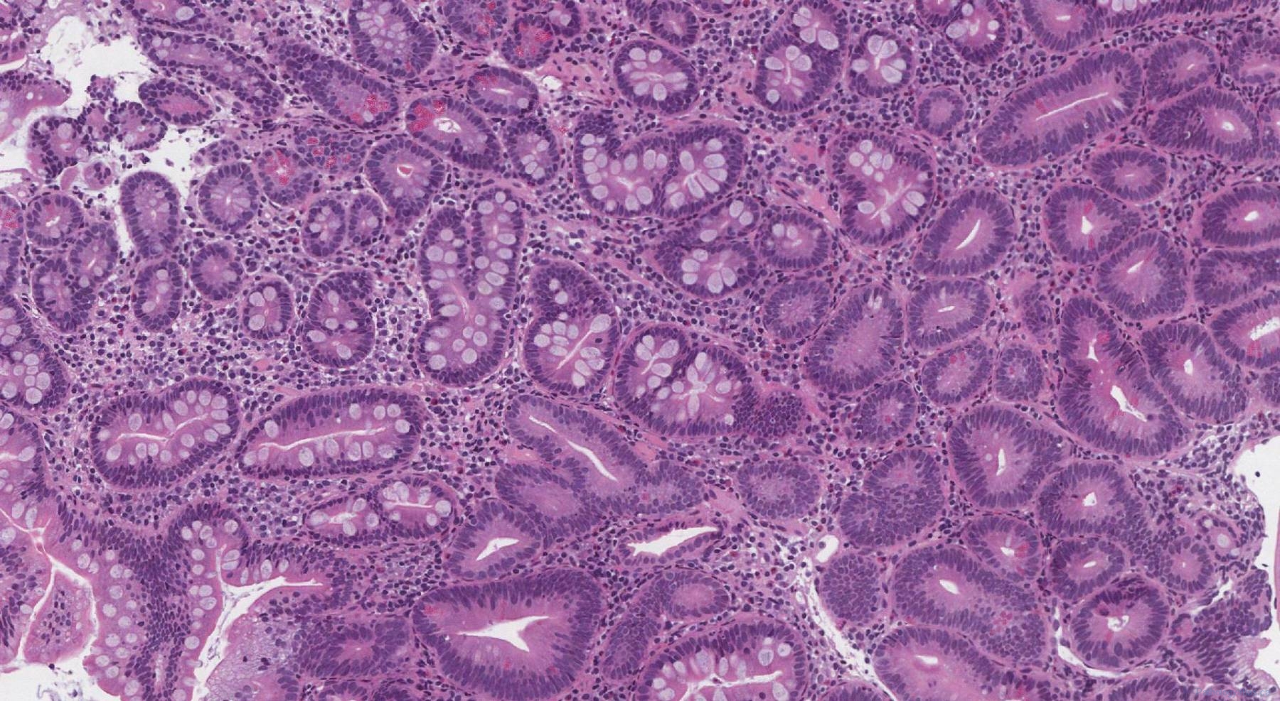 Non-ampullary duodenal adenoma | Atlas of Pathology