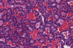 Non-intestinal type sinonasal adenocarcinoma