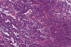 Non-intestinal type sinonasal adenocarcinoma