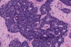 Non-intestinal sinonasal adenocarcinoma