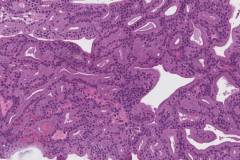 Non-intestinal sinonasal adenocarcinoma