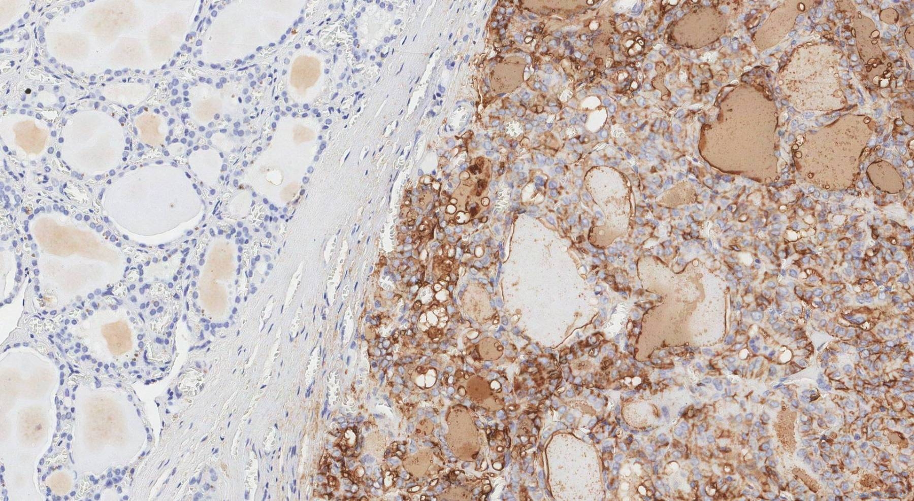 Non Invasive Follicular Thyroid Neoplasm With Papillary Like Nuclear Features Atlas Of Pathology