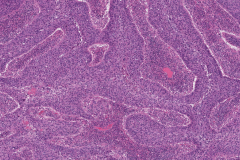 Nonkeratinizing squamous cell carcinoma of the nasal cavity