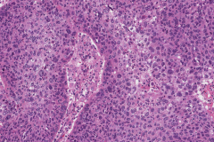 Nonkeratinizing squamous cell carcinoma of the nasal cavity