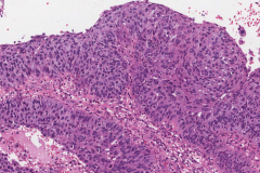 Nonkeratinizing squamous cell carcinoma of the nasal cavity