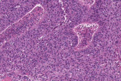 Nonkeratinizing squamous cell carcinoma of the nasal cavity