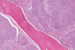 Nonkeratinizing squamous cell carcinoma of the nasal cavity