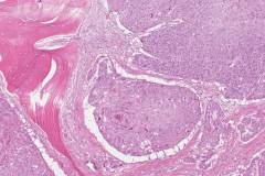 Nonkeratinizing squamous cell carcinoma of the nasal cavity