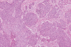 Nonkeratinizing squamous cell carcinoma of the nasal cavity