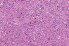 Nonkeratinizing squamous cell carcinoma of the nasal cavity