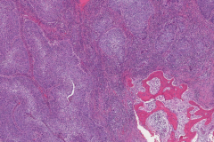 Nonkeratinizing squamous cell carcinoma of the nasal cavity