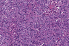 Nonkeratinizing squamous cell carcinoma of the nasal cavity