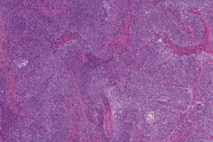 Nonkeratinizing squamous cell carcinoma of the nasal cavity