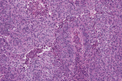 Nonkeratinizing squamous cell carcinoma of the nasal cavity