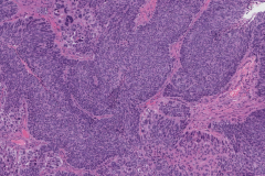 HPV-associated nonkeratinizing squamous cell carcinoma of the sinonasal tract