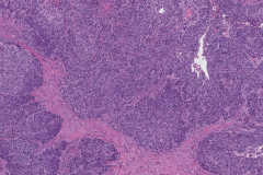 HPV-associated nonkeratinizing squamous cell carcinoma of the sinonasal tract