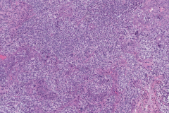 HPV-associated nonkeratinizing squamous cell carcinoma of the sinonasal tract