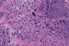 HPV-associated nonkeratinizing squamous cell carcinoma of the sinonasal tract