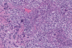 HPV-associated nonkeratinizing squamous cell carcinoma of the sinonasal tract