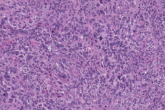 HPV-associated nonkeratinizing squamous cell carcinoma of the sinonasal tract