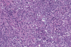 HPV-associated nonkeratinizing squamous cell carcinoma of the sinonasal tract