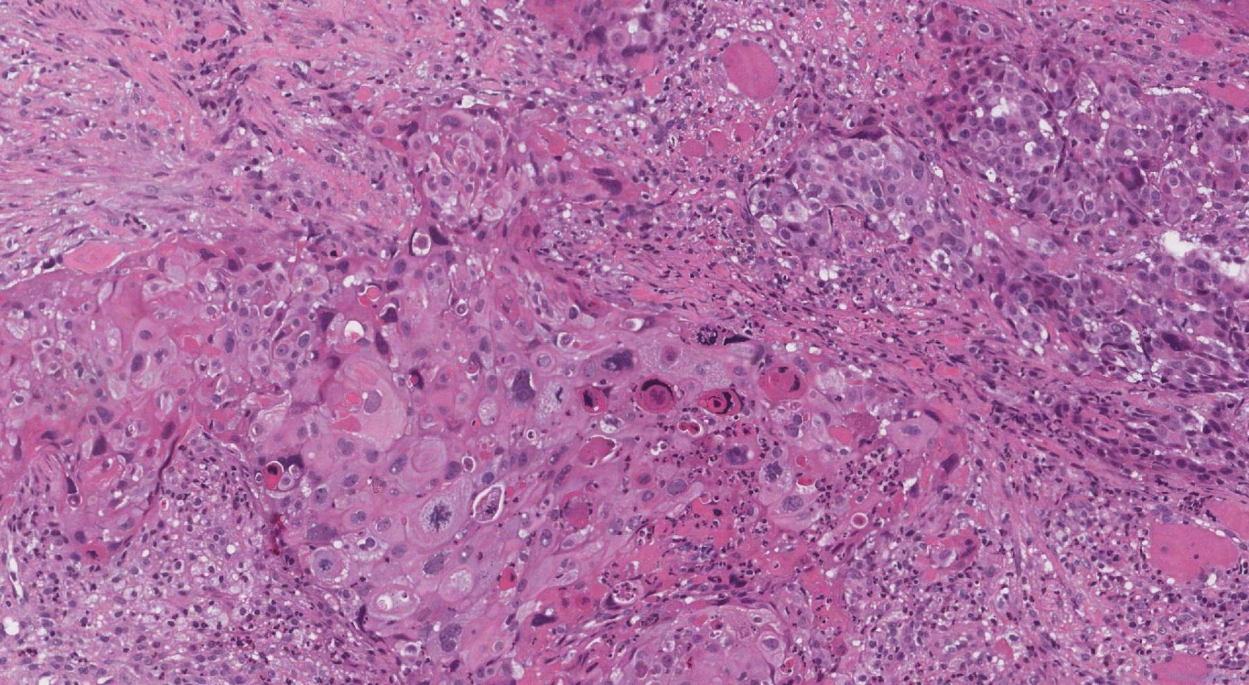 Hpv Associated Squamous Cell Carcinoma Of The Oropharynx Atlas Of Pathology