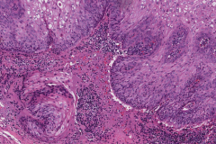 Papillary variant squamous cell carcinoma of the oropharynx