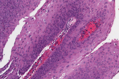 Papillary variant squamous cell carcinoma of the oropharynx