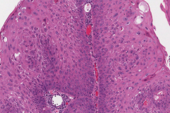 Papillary variant squamous cell carcinoma of the oropharynx