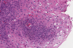 Papillary variant squamous cell carcinoma of the oropharynx