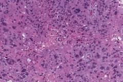 Nonkeratinizing squamous cell carcinoma of the oropharynx