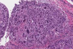 Nonkeratinizing squamous cell carcinoma of the oropharynx