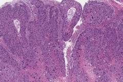 Nonkeratinizing squamous cell carcinoma of the oropharynx