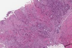 HPV-associated keratinizing squamous cell carcinoma of the oropharynx